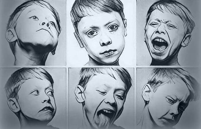 DBS in Obsessive-Compulsive Disorder (OCD)