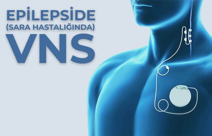 What is Epilepsy?
