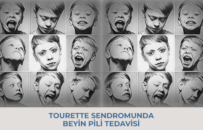 DBS in Tourette Syndrome